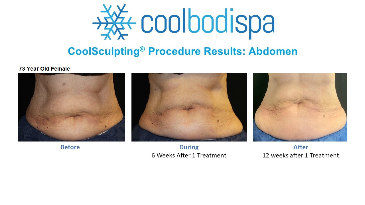 BO CS (Abs) Comparison - Rx