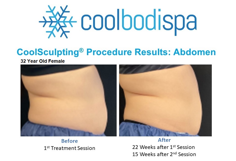 Bretlie R (Abs) CS Comparison (rt profile)
