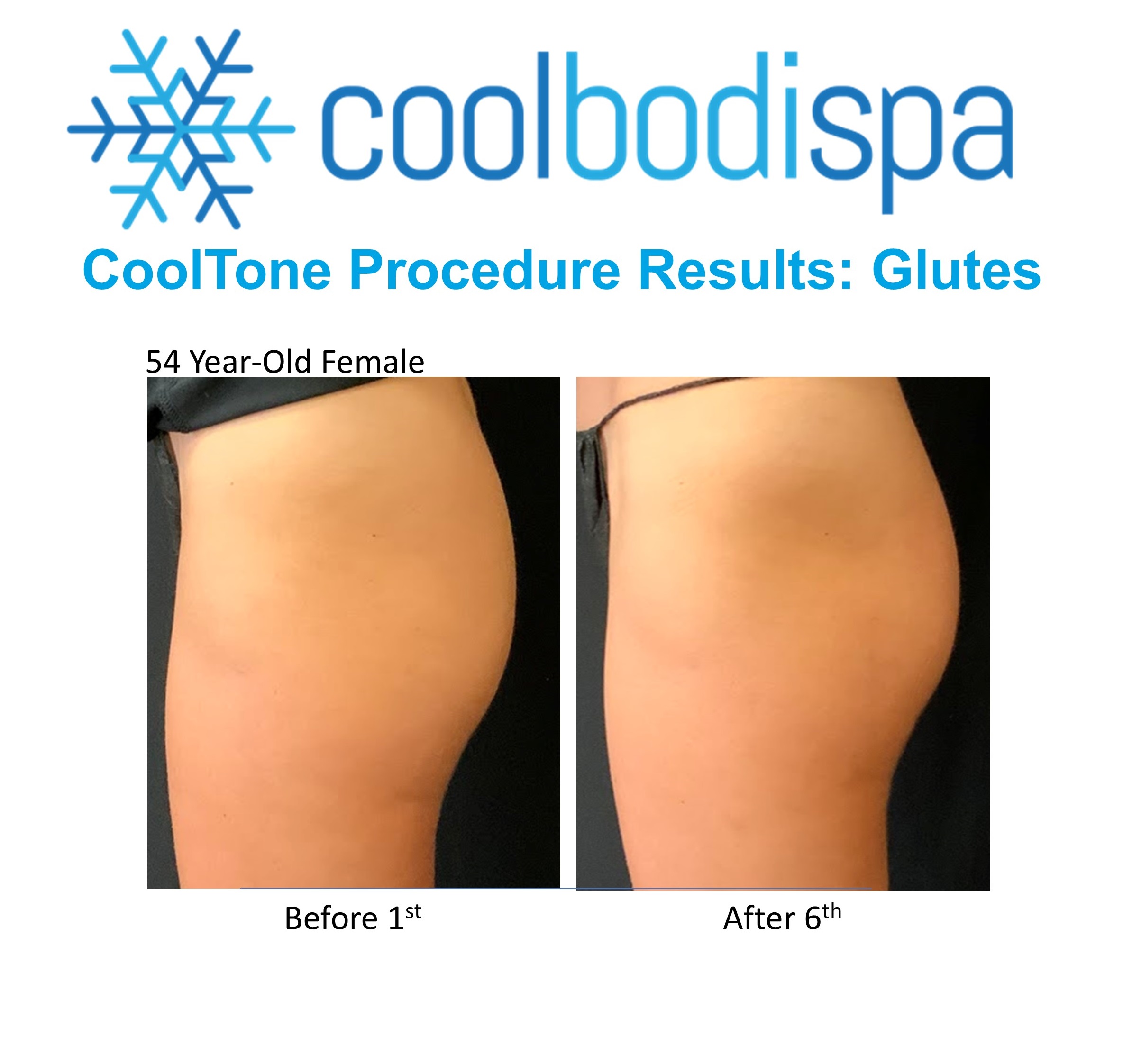 Brittany S (Glutes) CoolTone Comparison Results