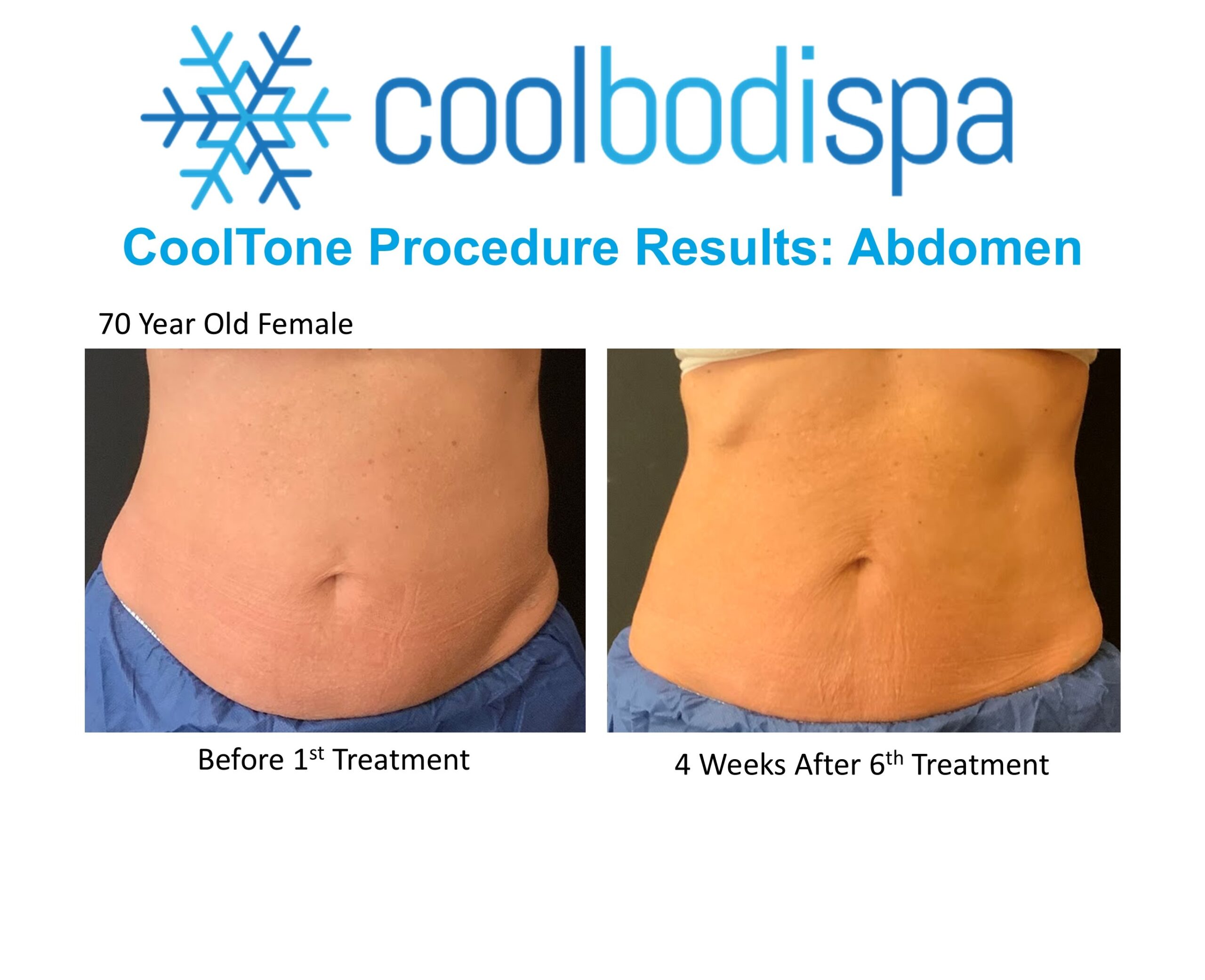 Candyce F(Abs) CoolTone Comparison Results