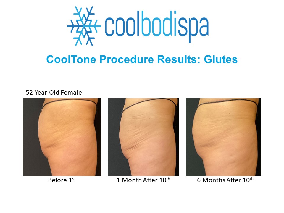 DW 6mos CT Glutes Rt Side