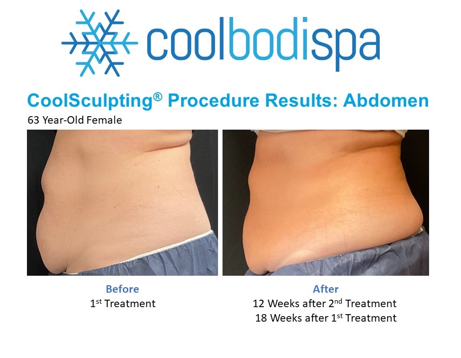 KQ (Abs) CS Comparison (2)