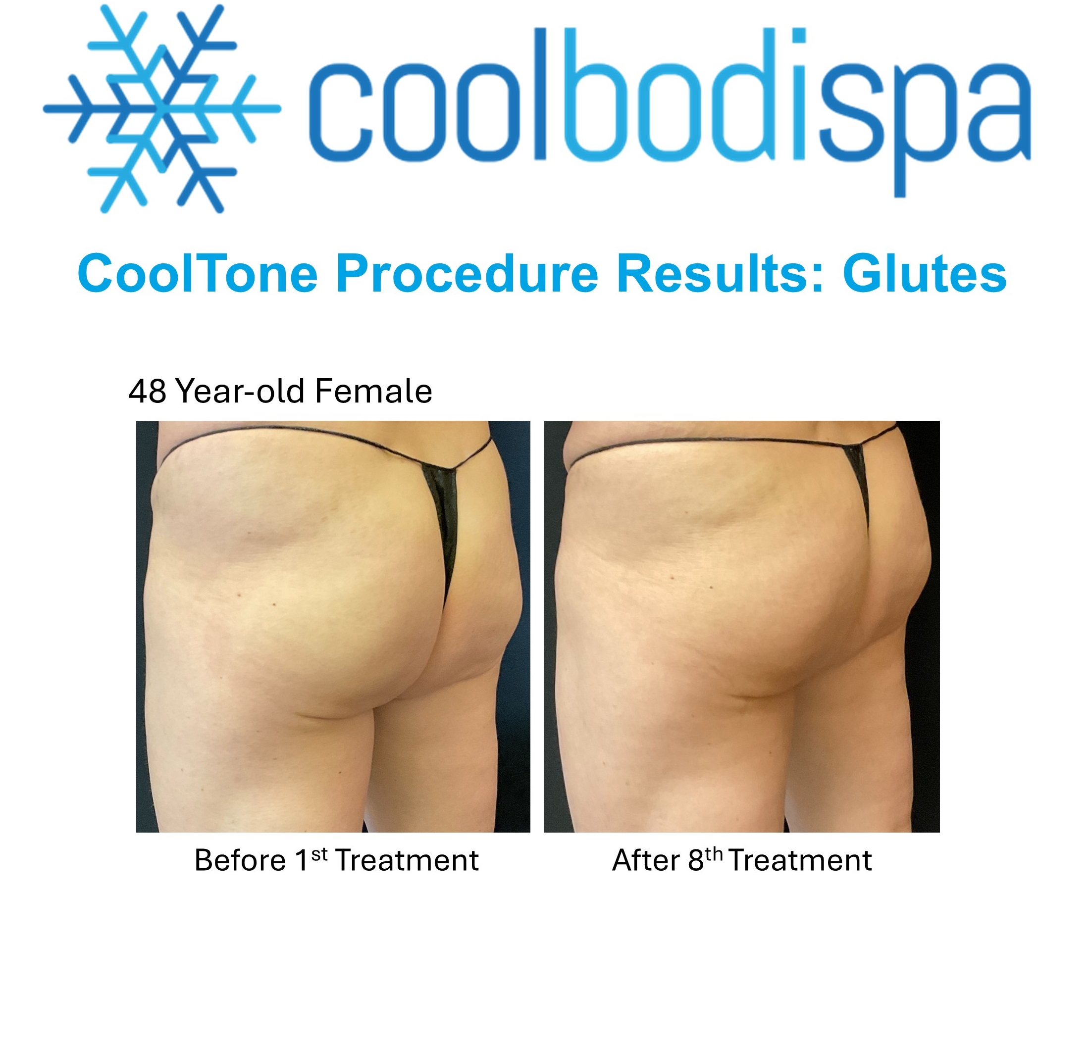 Karen B (Glutes) CT Comparison
