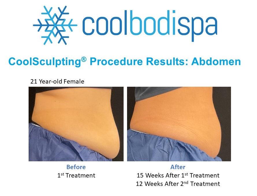 Meadow (Abs-90) CS Comparison