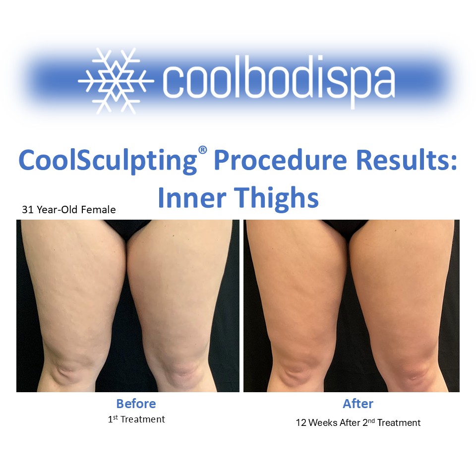 BR (InThigh) CS Comparison (Square)