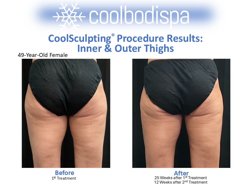 JFoster (I&O Thighs) CS Comparison