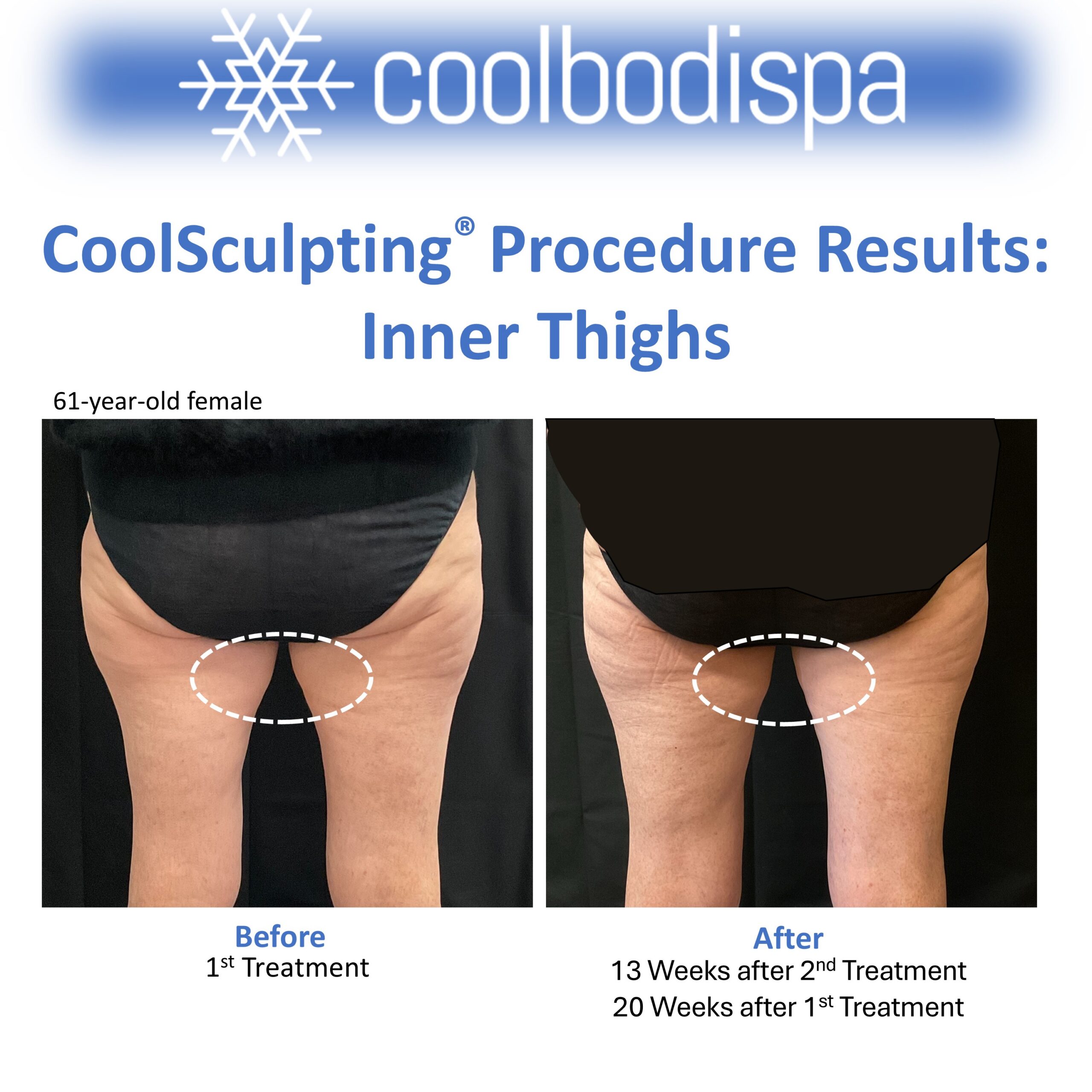 Jo M (Inner Thigh) CS Comparison (Square)