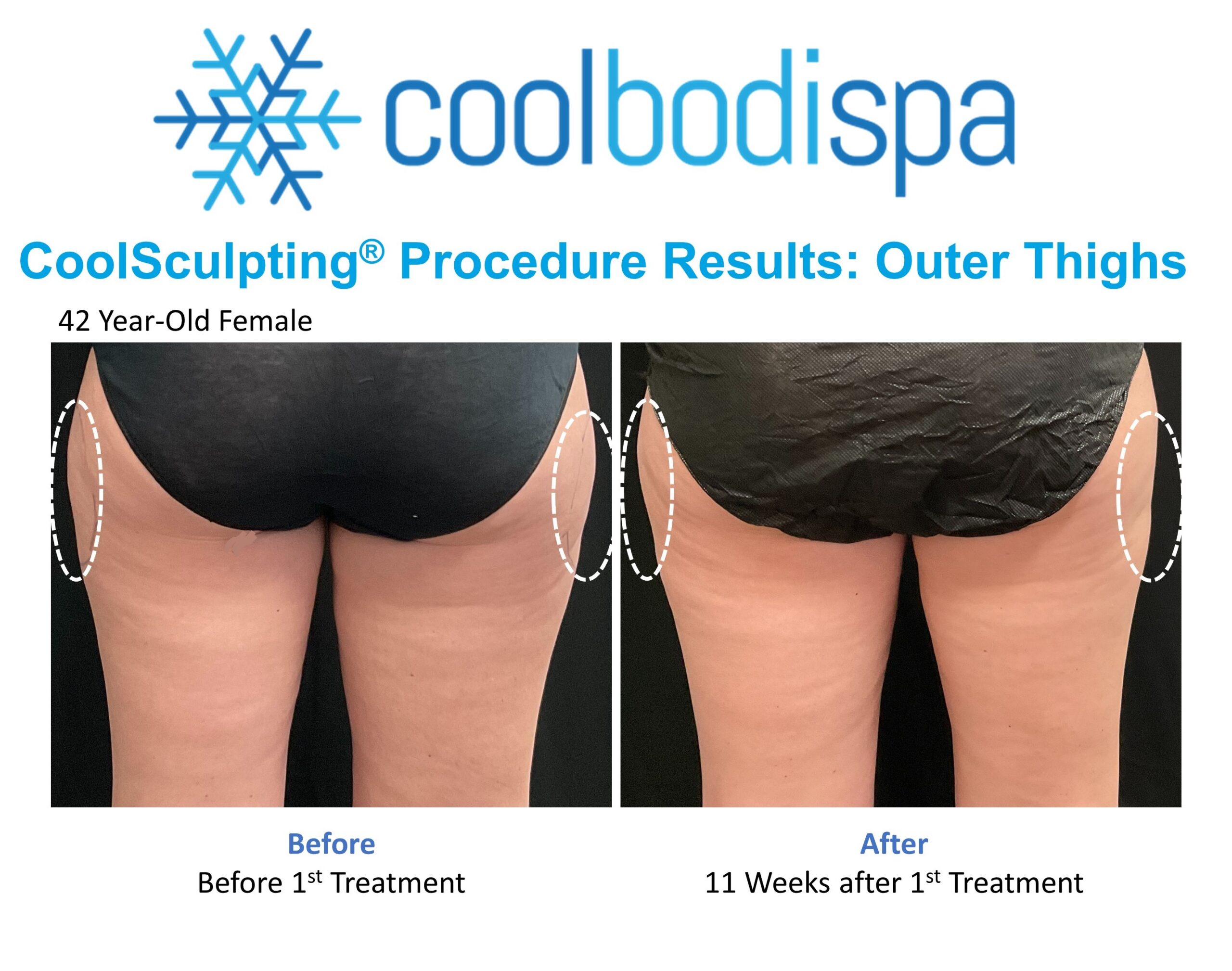 Lauren (Out Thigh) CS Comparison
