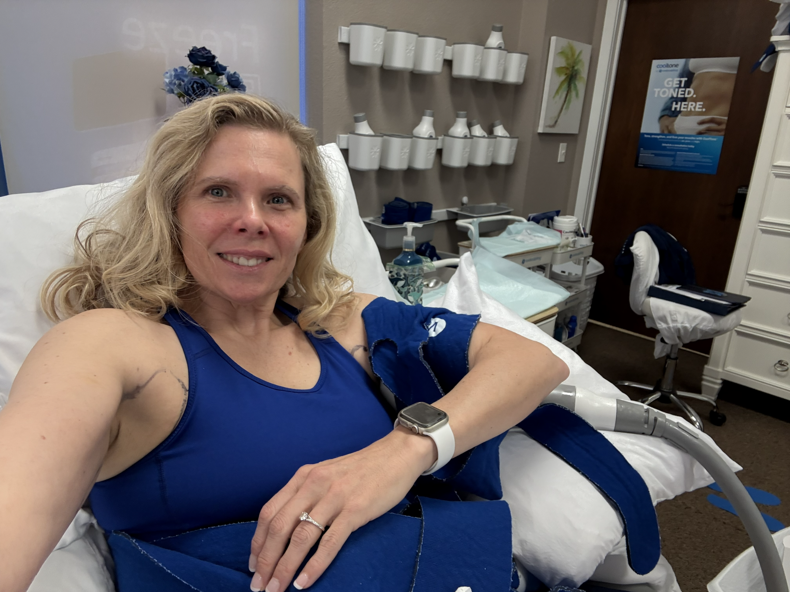CoolSculpting abdomen treatment at CoolBodiSpa, Norman Oklahoma