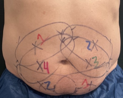 Comprehensive CoolSculpting treatment plan for a male client at CoolBodiSpa, Norman Oklahoma