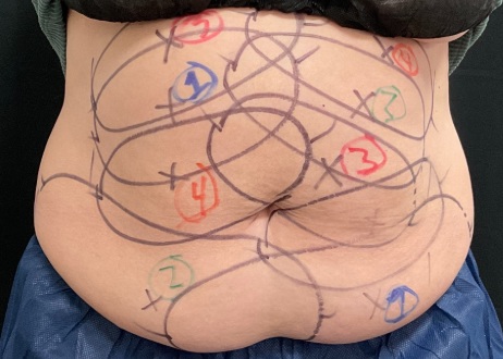 CoolSculpting treatment plan marked on a client's abdomen at CoolBodiSpa, Norman Oklahoma