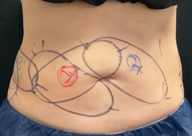 Personalized CoolSculpting treatment plan on a second client's abdomen, Norman Oklahoma